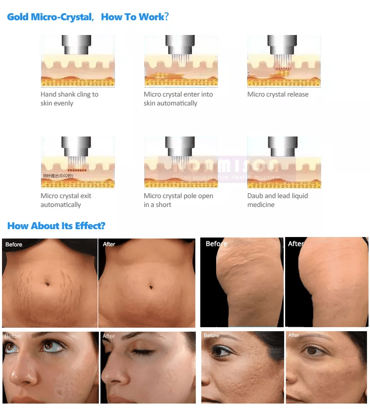 Top Seller Radio Frequency Rf Microneedling Machine Microneedle Rf Machine - CSTrueBeauty