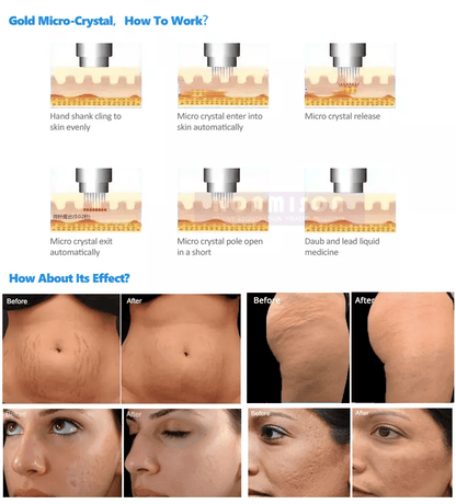 Top Seller Radio Frequency Rf Microneedling Machine Microneedle Rf Machine - CSTrueBeauty